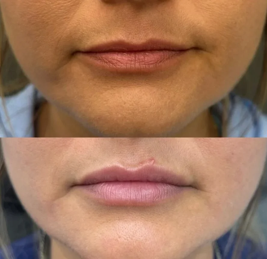Before-and-After-Lip-Filler-Treatment-p