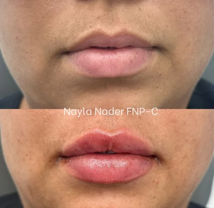 Before-and-After-Lip-Filler-Treatment-q