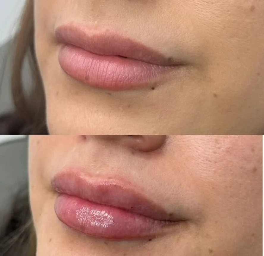 Before-and-After-Lip-Filler-Treatment-r