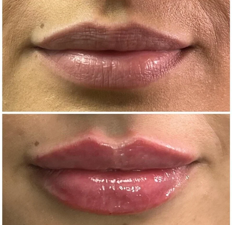 Before and After Lip Filler Treatment