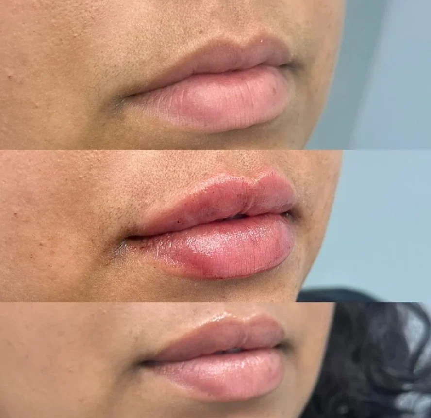 Before-and-After-Lip-Filler-Treatment-s