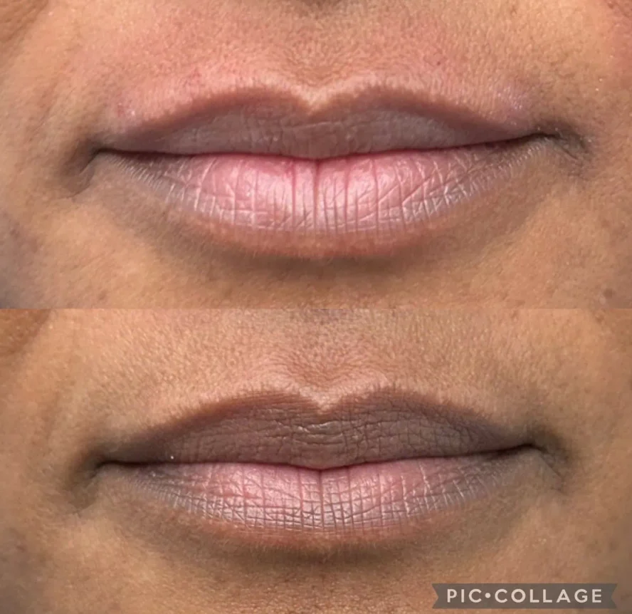 Before and After Lip Flip With Botox a