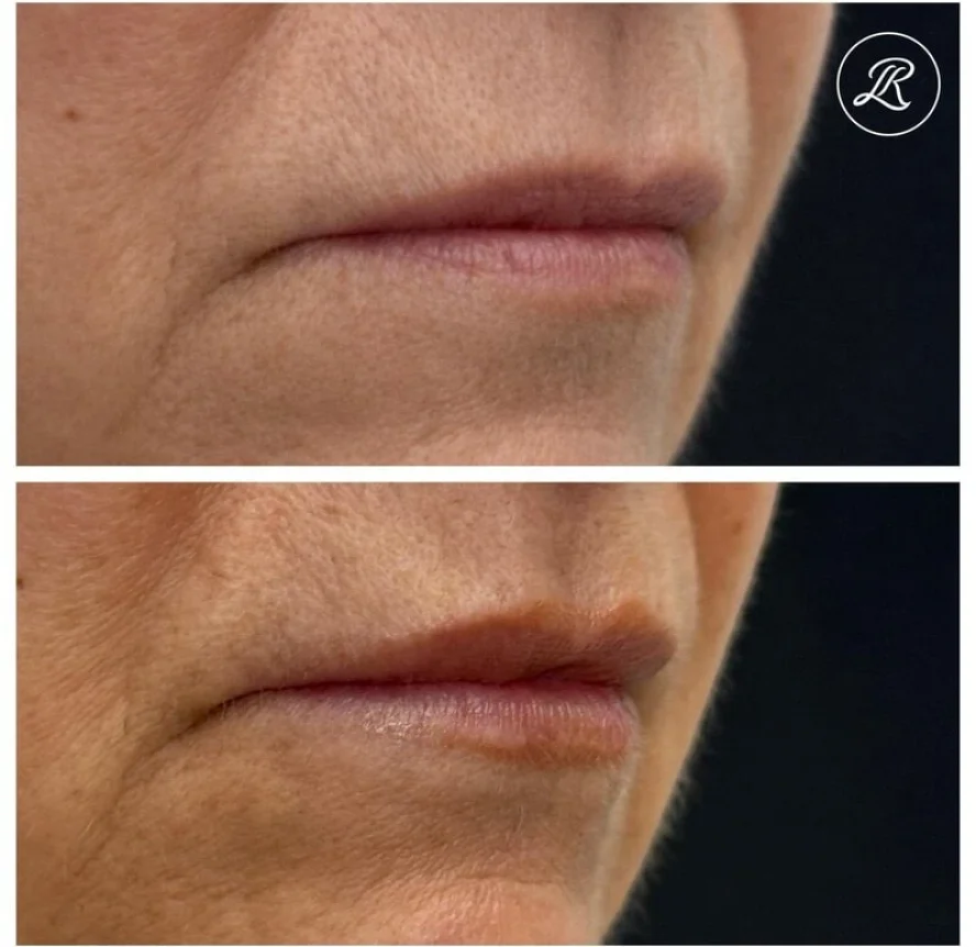 Before and After Lip Flip With Botox b