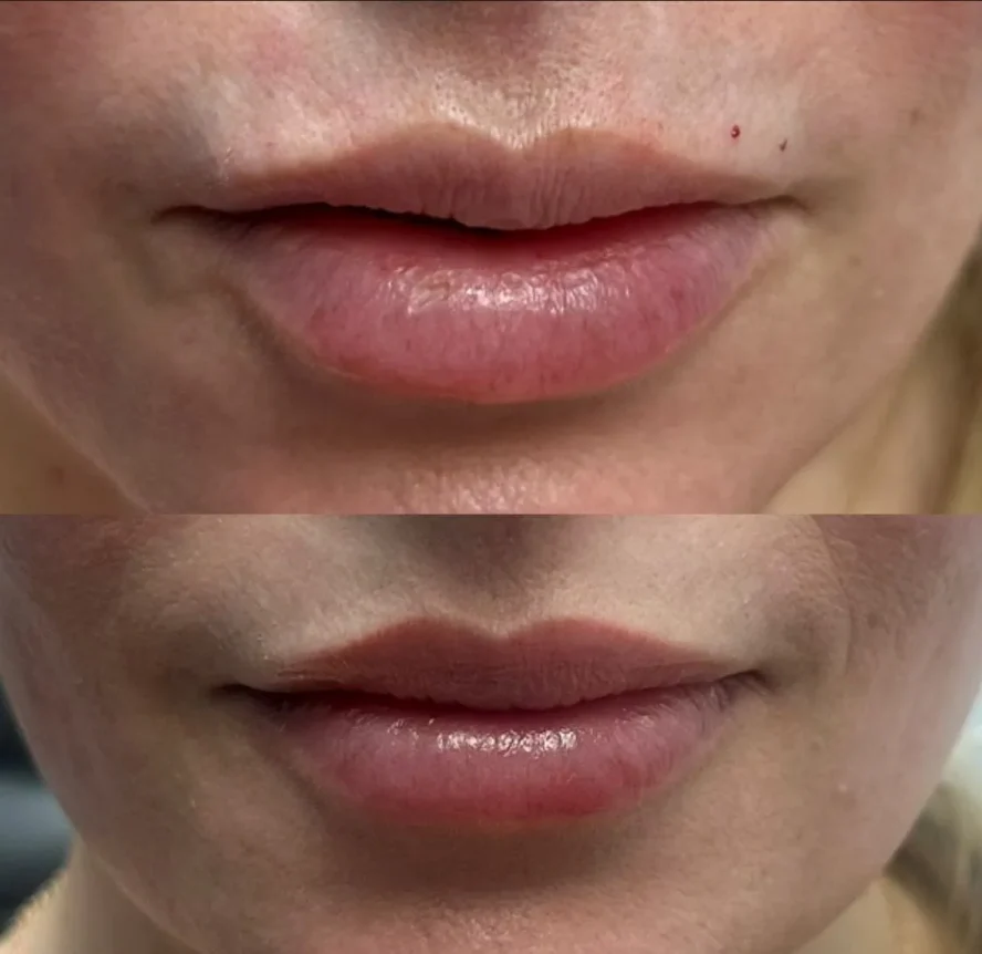 Before and After Lip Flip With Botox