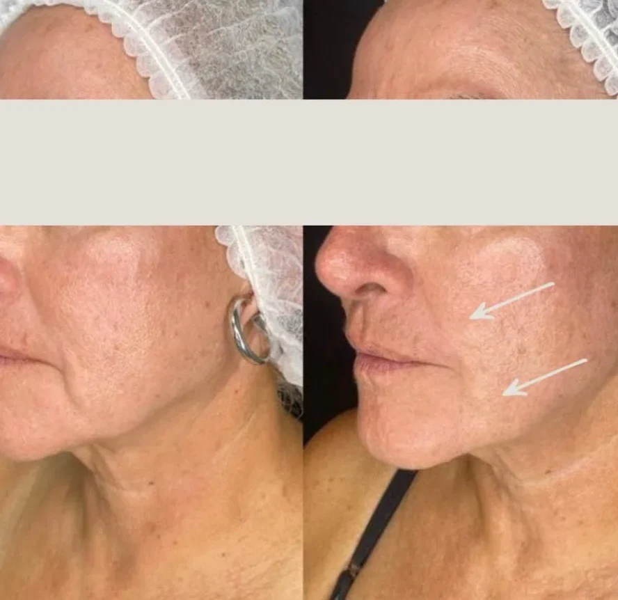 Before and After Morpheus8 Face a