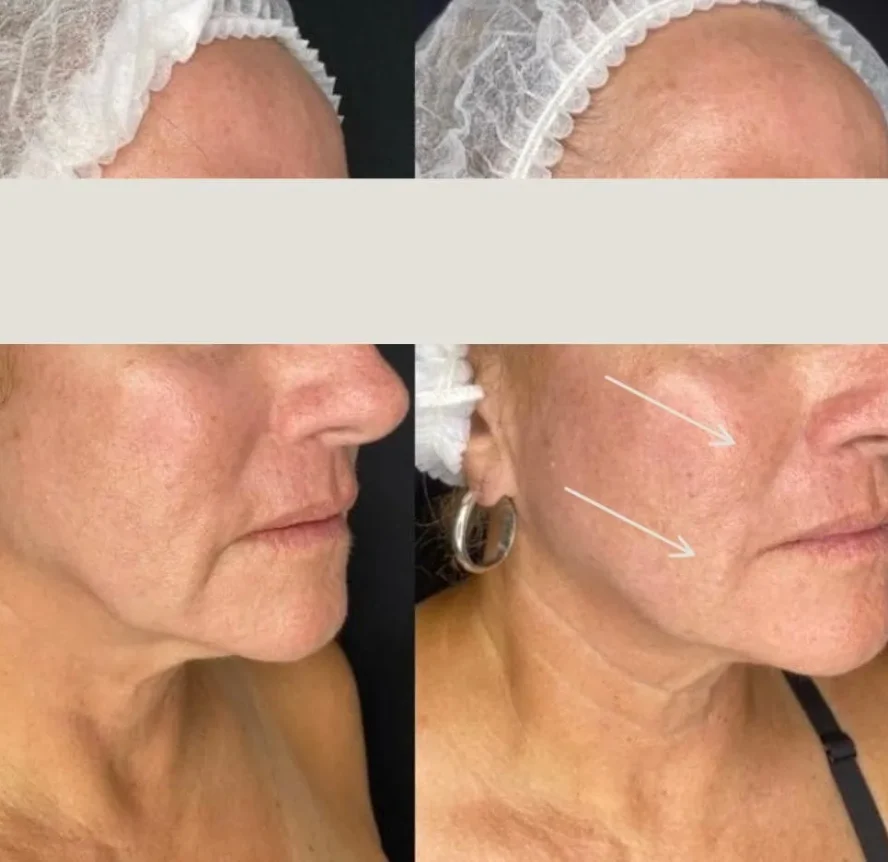 Before and After Morpheus8 Face