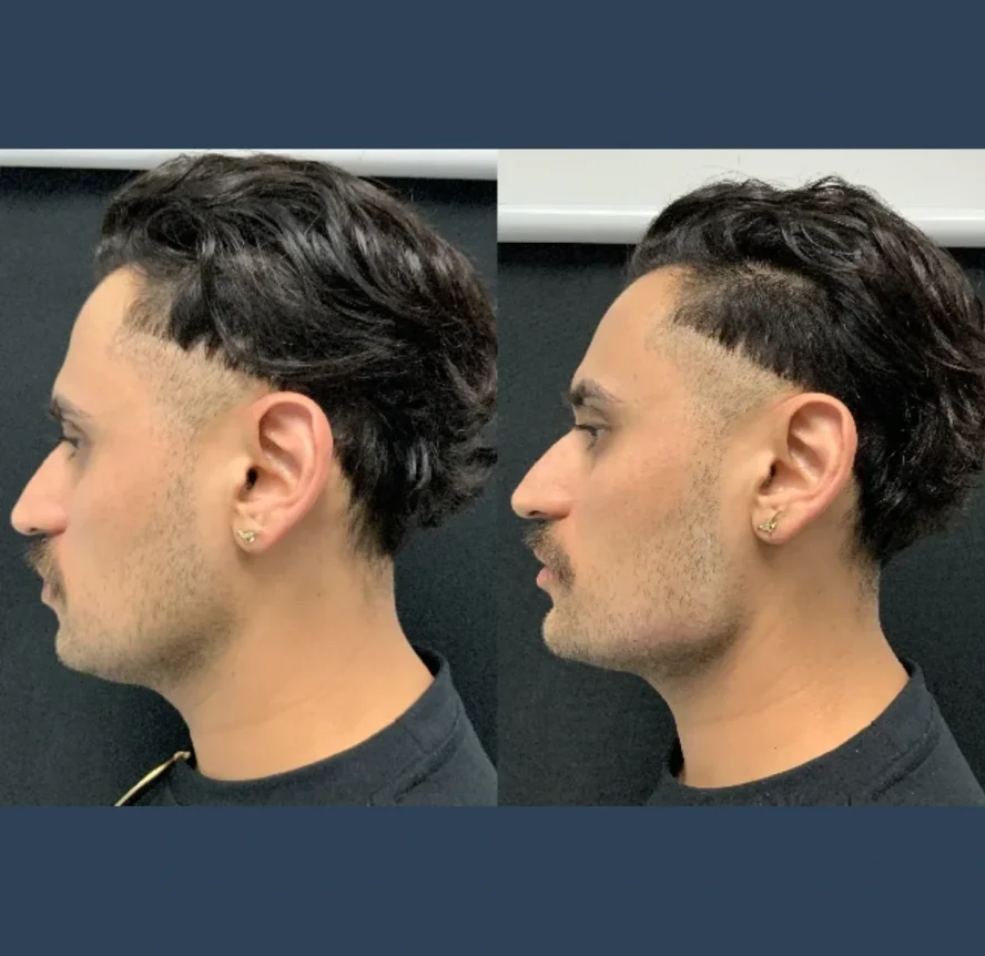 Before-and-After-Non Surgical Jawline Contouring