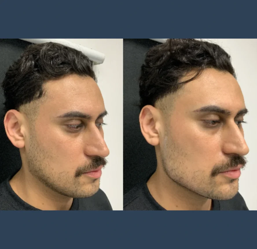 Before-and-After-Non-Surgical-Non Surgical Jawline Contouring
