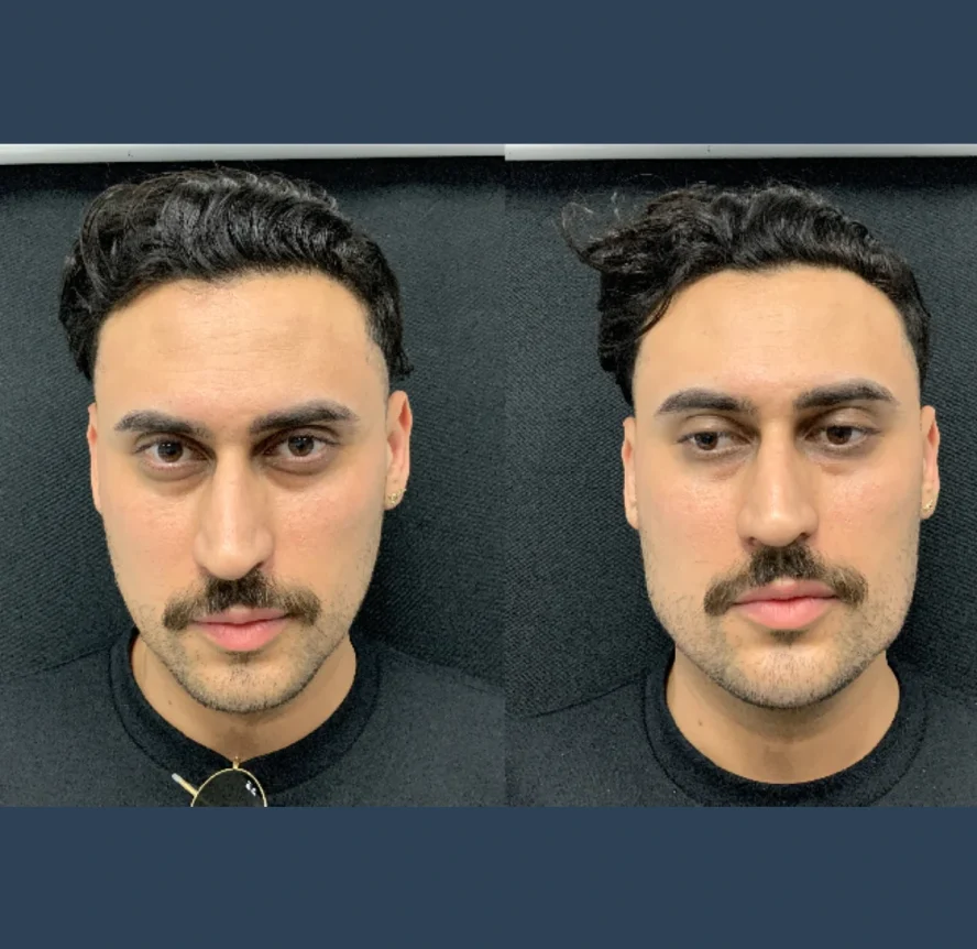 Before-and-After-Non-SurgicalNon Surgical Jawline Contouring