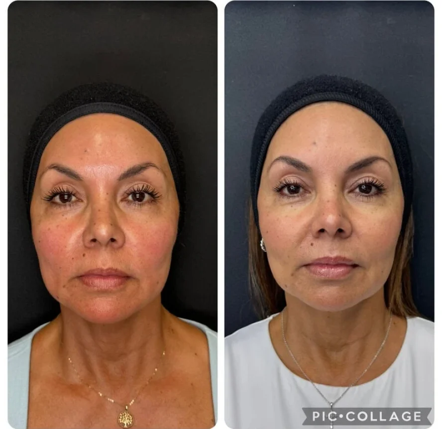 Before and After Sculptra Treatment a