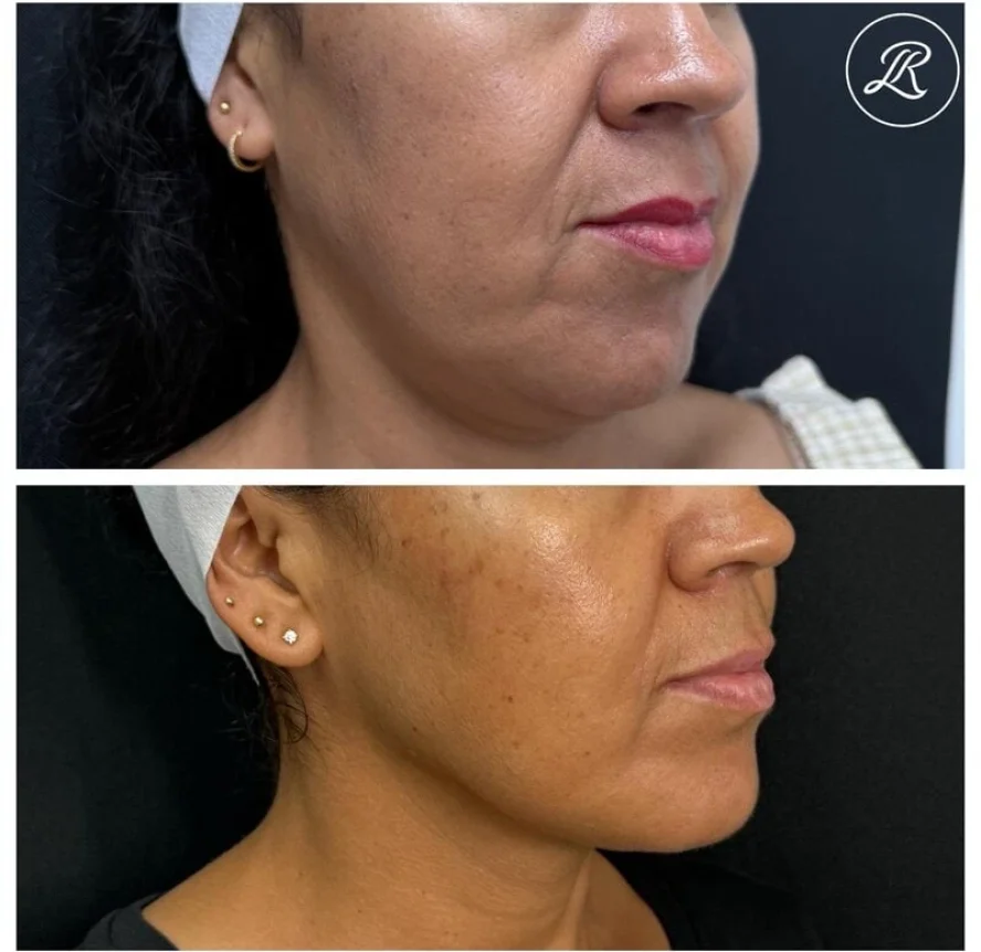 Before and After Sculptra Treatment b