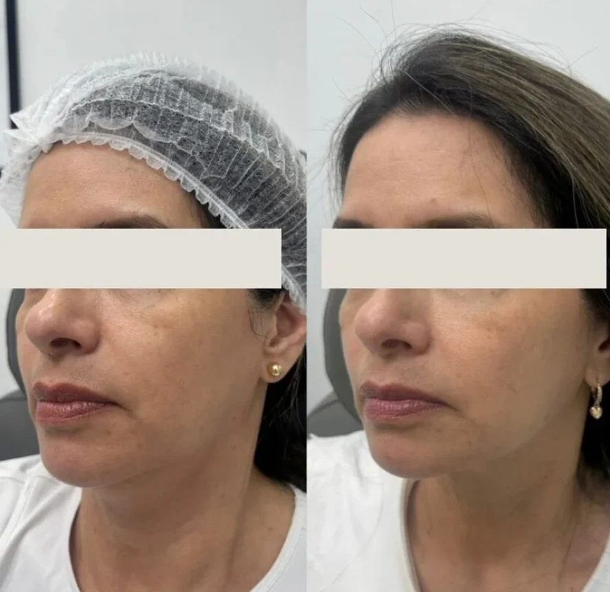 Before and After Sculptra Treatment