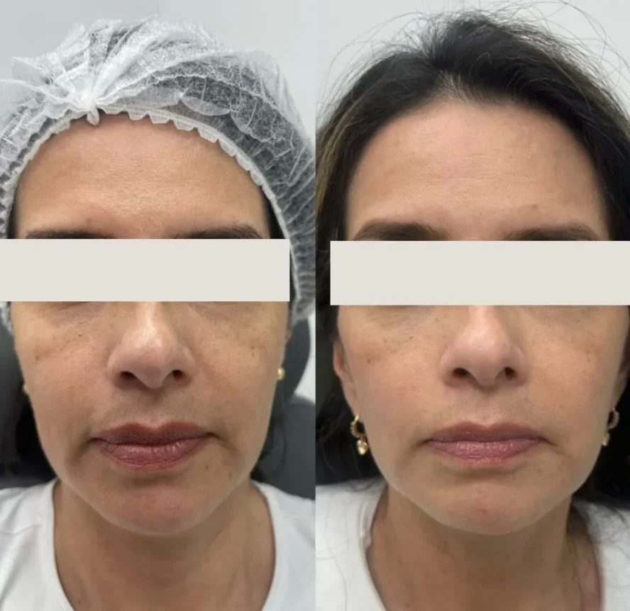 Before and After Sculptra a