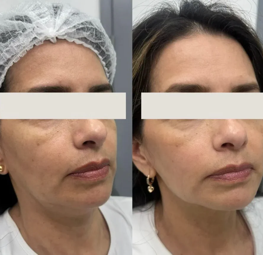 Before and After Sculptra