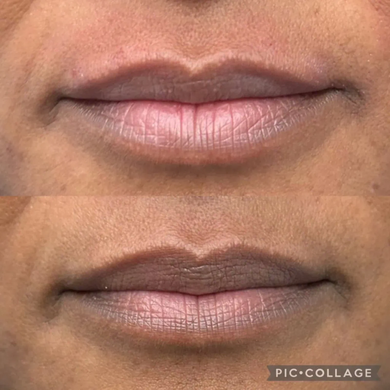 Before and After lip flip a