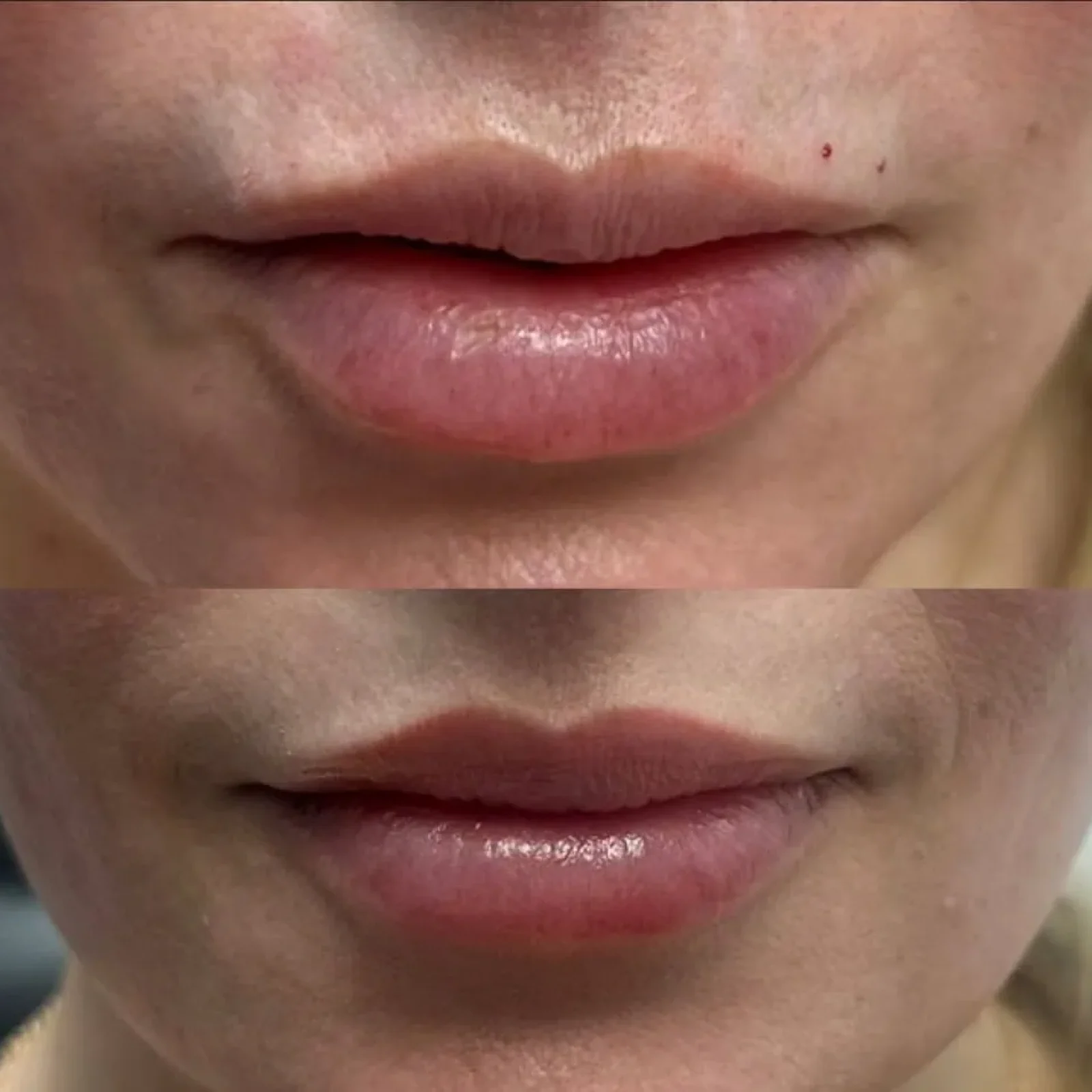 Before and After lip flip