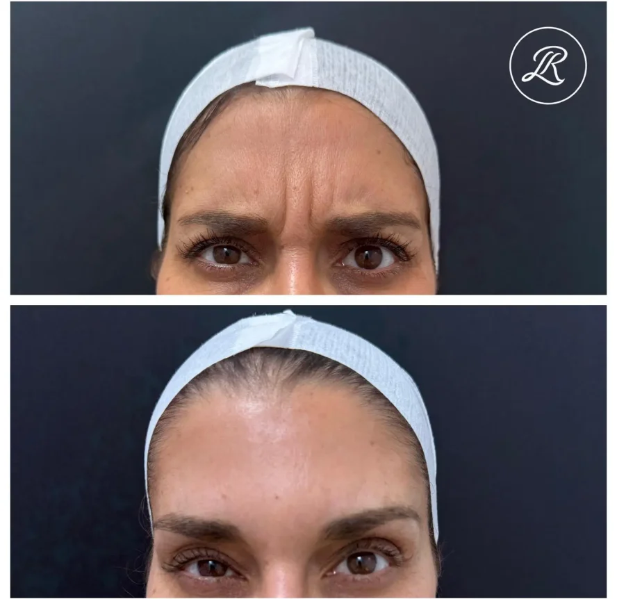 Before and After Botox