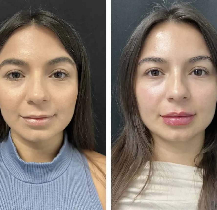 Maidely-Medina-Lip Filler