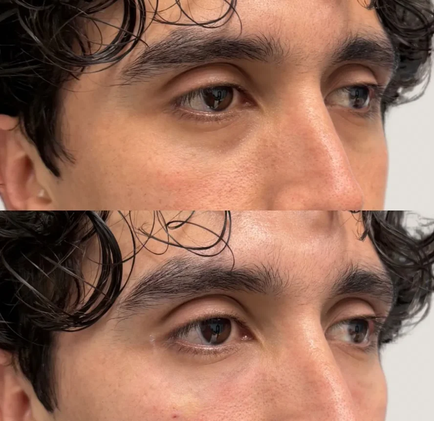 Before and After Under-Eye Filler