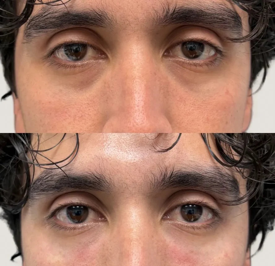 Before and After Under-Eye Filler