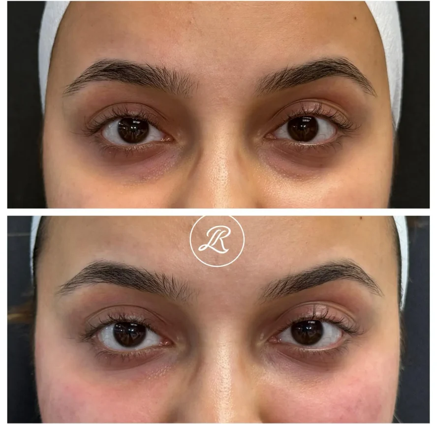 Before and After Under-Eye Filler