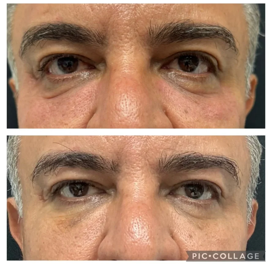 Before and After Under-Eye Filler