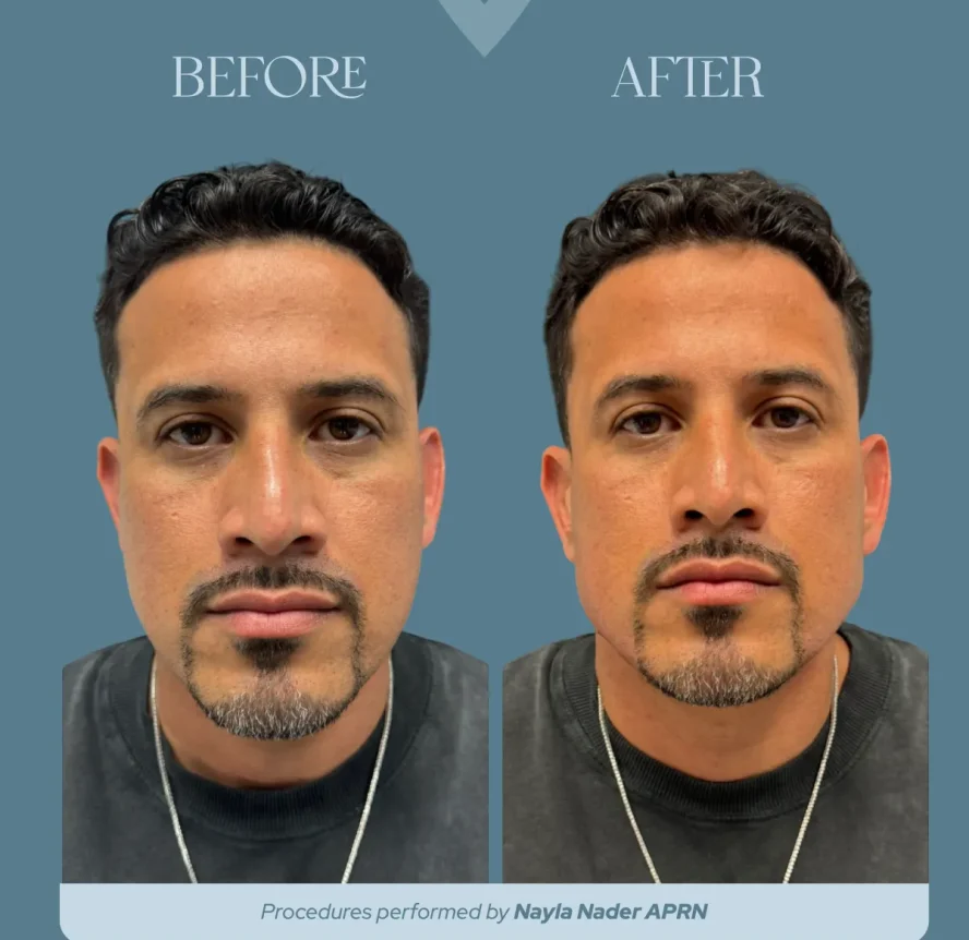 non surgical ba